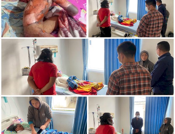 SEORANG ANAK MENGALAMI LUKA BAKAR AKIBAT LEDAKAN MERCON KALENG RAKITAN