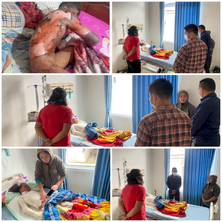 SEORANG ANAK MENGALAMI LUKA BAKAR AKIBAT LEDAKAN MERCON KALENG RAKITAN